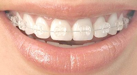 矫正牙齿有哪些好方法?