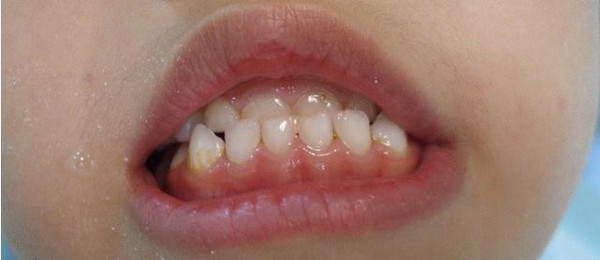 各位妈妈赶紧补补课,如何预防幼儿牙齿反合?