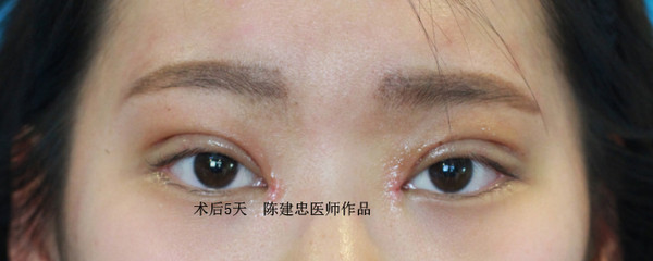 (图)双眼皮手术恢复过程是怎么样的