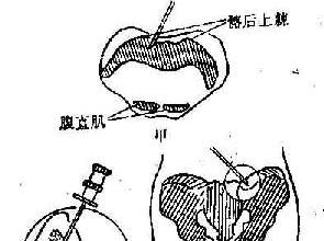 分】   (1)患者体位(与选择穿刺部位有关可任选一个穿剌点)正确(2分)