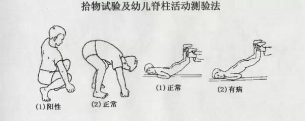 宝宝仅6个月脊柱就变形,原来竟然是它