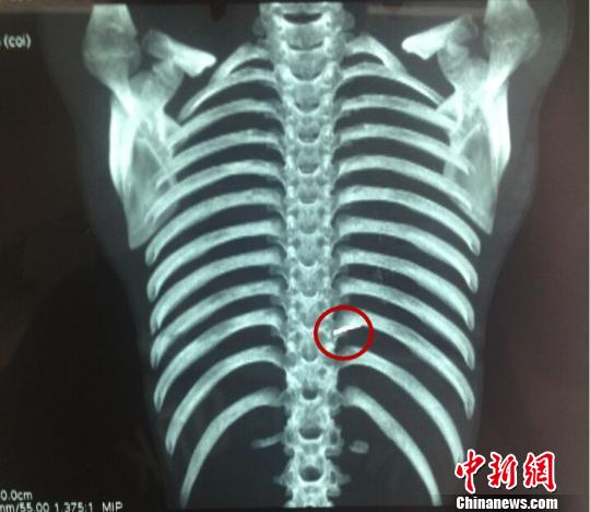 CT显示，小照左侧胸壁有细小针状物。 牛志信 摄