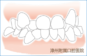 漳州牙齿矫正专家谈:学生哪些情况需要做牙齿