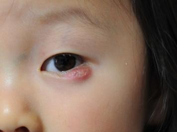 针眼麦粒肿眼睑炎怎么快速治疗