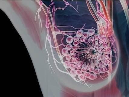 【组图】乳腺癌也微创——乳腺癌的腔镜治疗