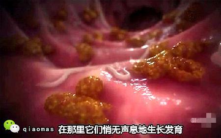 青青岛社区 亲子论坛    肠管内蛔虫,若钻进胆管引起胆道蛔虫症,胆管