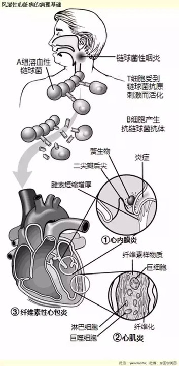 【一图就懂】风湿性心脏病的病理基础