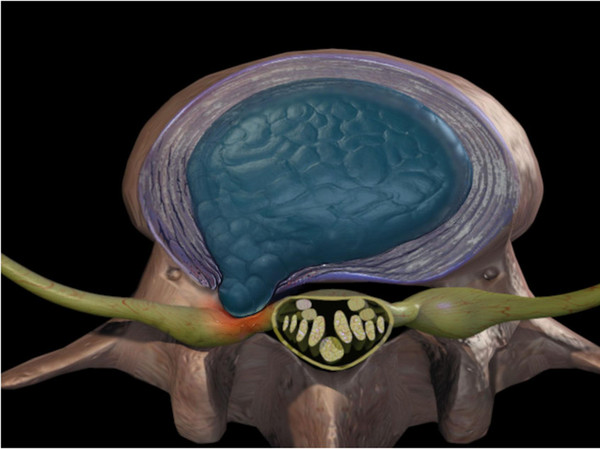 腰椎间盘突出    之前都说过我们诊断腰椎间盘突出症主要是依靠ct,磁