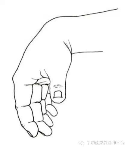 手和指的种种畸形直接影响手功能