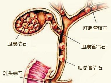 邢文荣:胆囊结石症状都有哪些