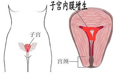 诊断性刮宫病理报告提示内膜单纯增生什么意思