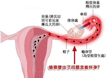 北京不孕不育医院专家谈如何疏通双侧输卵管堵