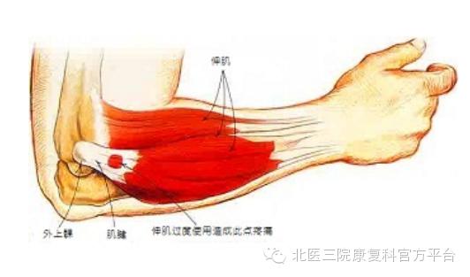 【防患于未然】科学运动--远离网球肘