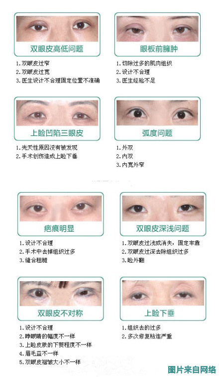 图双眼皮手术失败的8种表现