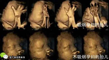 从上面的图片可以看出, 吸烟母亲腹中的胎儿,嘴动和用手摸自己的脸和