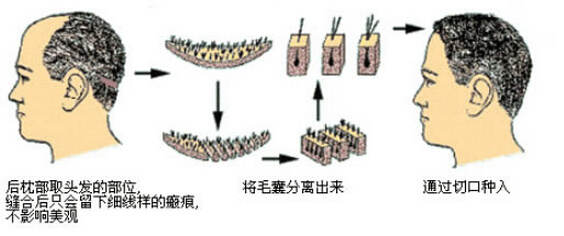 植发会损伤取发区毛囊吗?