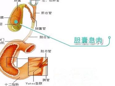 孕妇胆囊息肉