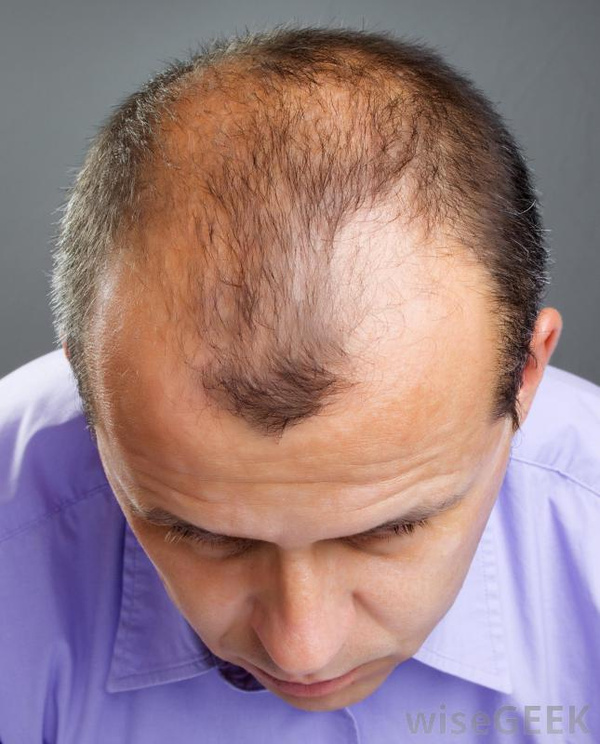 专家:男性脱发三特征 治疗是持久战(图)