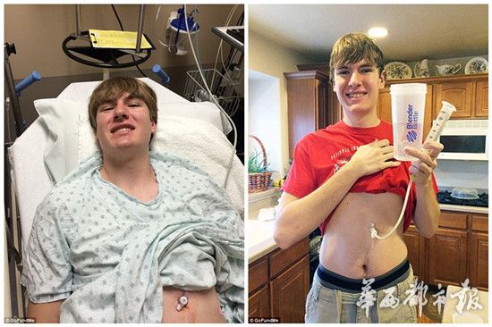 据每日邮报报道，19岁的阿历克斯・维凯斯来自美国犹他州，刚刚从高中毕业的他看似与常人无异，但他得了一种怪异的过敏症。阿历克斯对食物中的蛋白过敏，导致他无法吃任何食物，不得不依靠插在胃上的流食管道生活。
