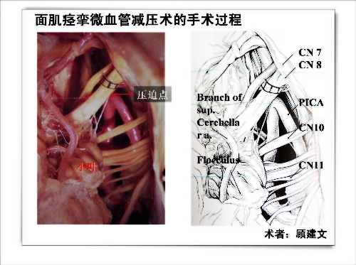 【组图】显微血管减压术治疗面肌痉挛的手术配合