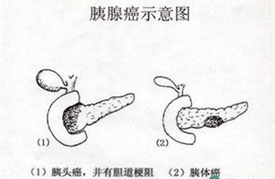 得了胰头癌晚期能活多久