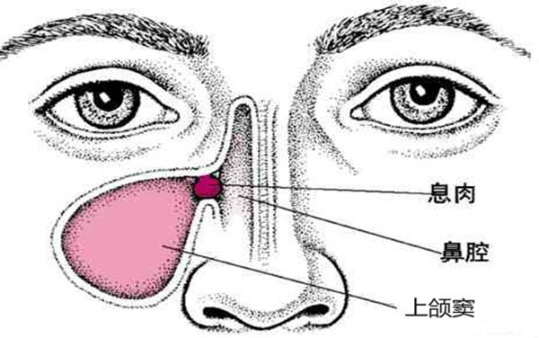 鼻息肉并非真性肿瘤,往往是变态反应和鼻窦慢性发炎引起的鼻粘膜水肿
