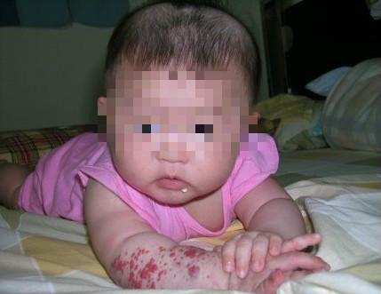 婴儿身上无故长出一个红点,检查完吓坏了妈妈