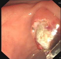 十二指肠乳头结石嵌顿 ercp:胆总管多枚结石