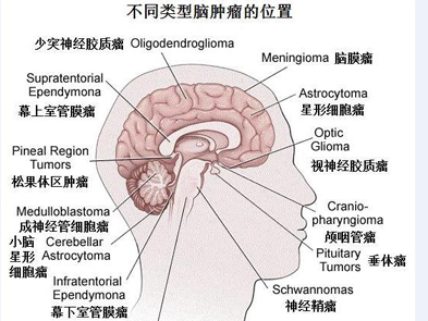 赴美就医:脑肿瘤基本知识