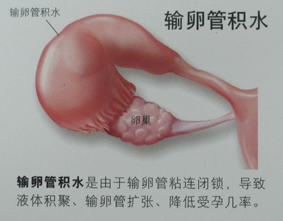 输卵管积水与试管婴儿