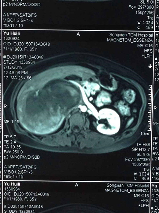 高危右肾上腺嗜铬细胞瘤在洛阳新区医院成功切
