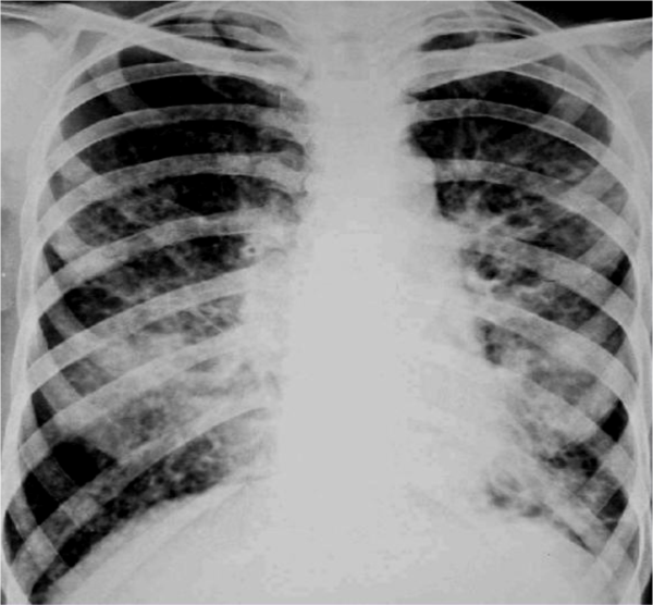 实践技能辅助检查之普通x线影像诊断(二)肺炎