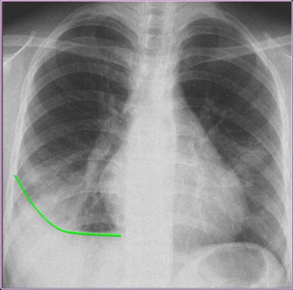 游离性胸腔积液: (1)少量积液:首先在侧位胸片上显示后肋膈角变钝.