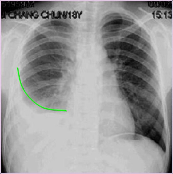 实践技能辅助检查之普通x线影像诊断-胸腔积液