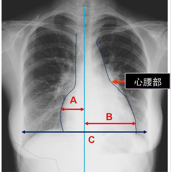 实践技能辅助检查之普通x线影像诊断-心脏增大