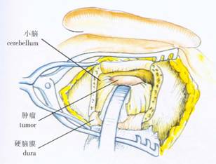 经乙状窦后径路肿瘤切除术(视频)