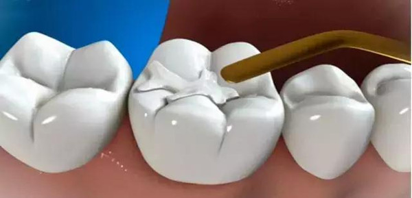 精妙图解补牙全过程,看完你就懂了