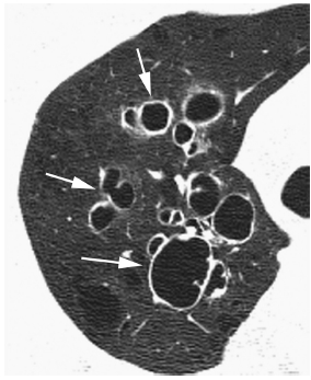 3类支气管扩张相关疾病的影像学(多图)