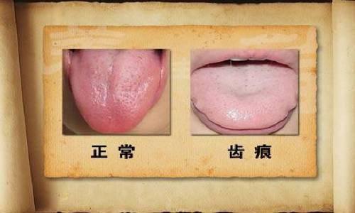 齿痕舌是怎么回事?