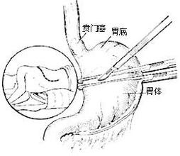 排骨癌晚期是否转移底座架子贲门沙发图片