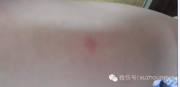 小孩在徐州春光游泳馆游泳后起红疹