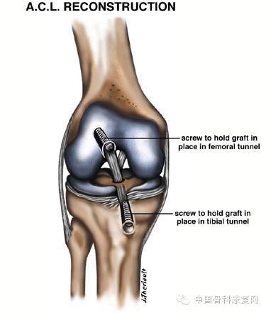 膝关节镜下自体韧带重建前交叉韧带的手术配合