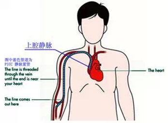 picc单腔与双腔导管实物(图3.超声引导下picc置管术(图4.
