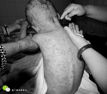 婴儿湿疹的图片图片