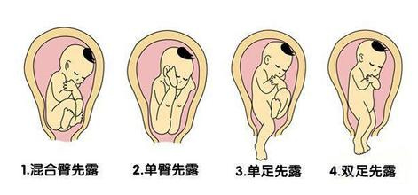 胎位不正的原因?