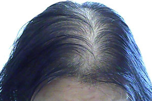 女性头顶脱发的原因和治疗