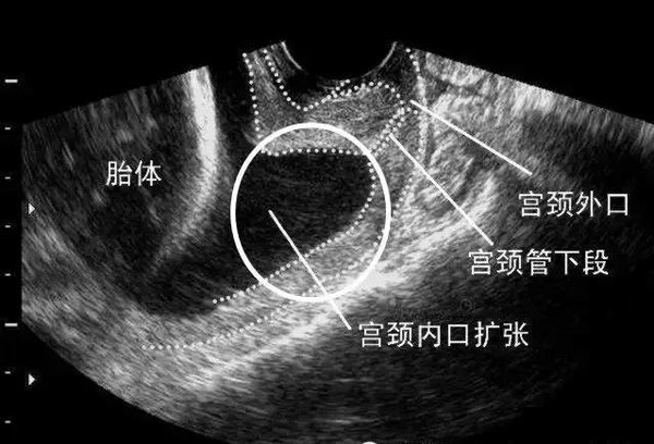 妊娠期宫颈内口扩张,宫颈管缩短b超成像图