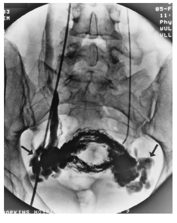 图19-5 mri-t2 显示左肾静脉被肠系膜上静脉压迫出现胡桃夹综合征一