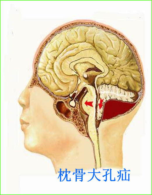 小脑扁桃体疝又称 枕骨大孔疝,大多发生于颅后窝血肿或占位病变,直接
