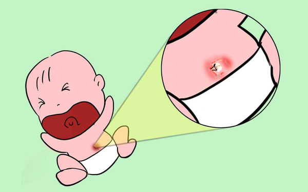 新生宝宝肚脐,该如何正确护理?